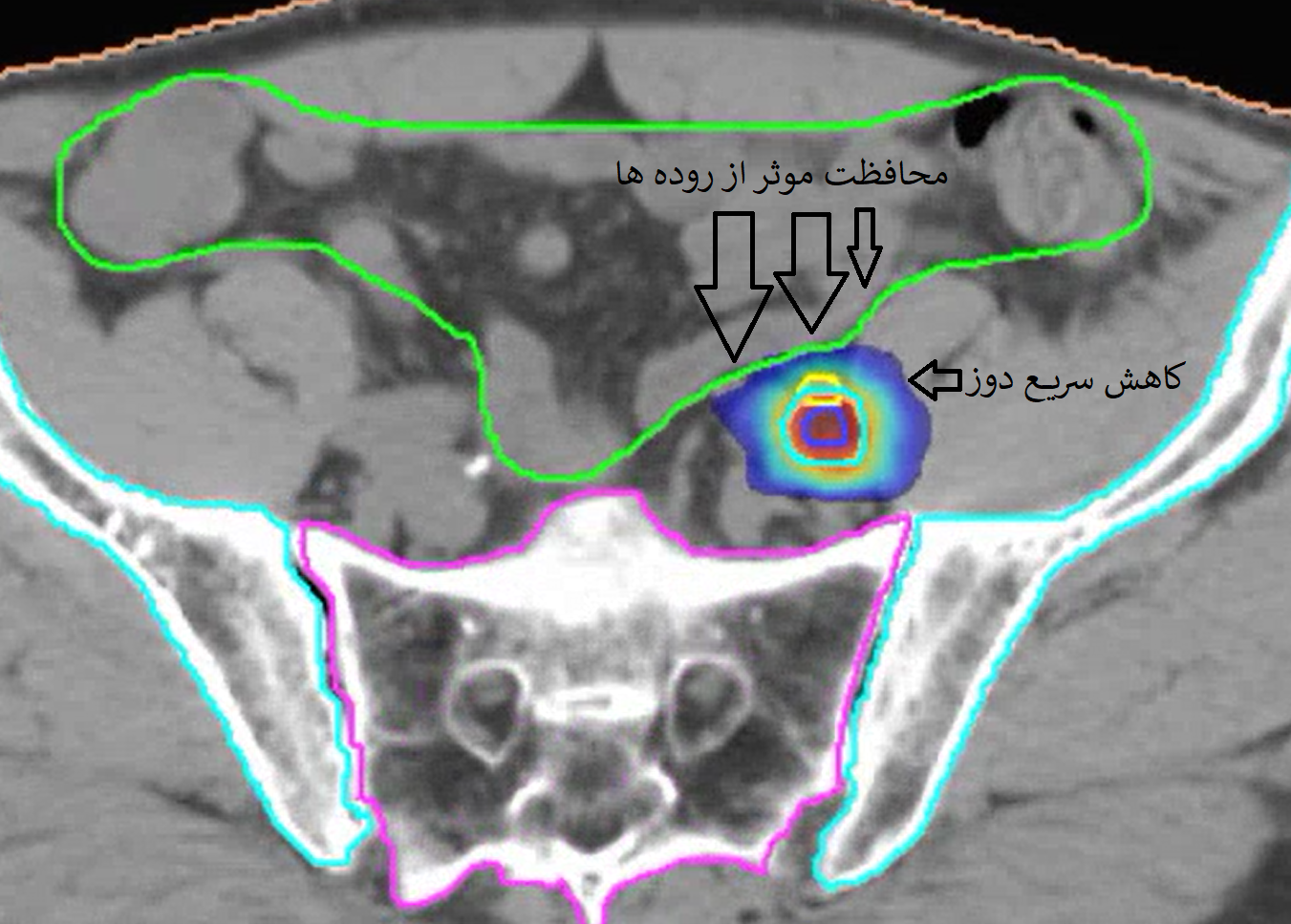 rapid dose fall off farisi